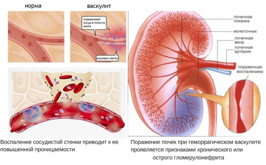 Васкулопатия это