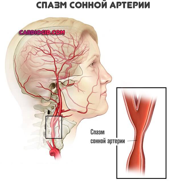 Почему спазм сосудов. Сонная артерия в головном мозге.