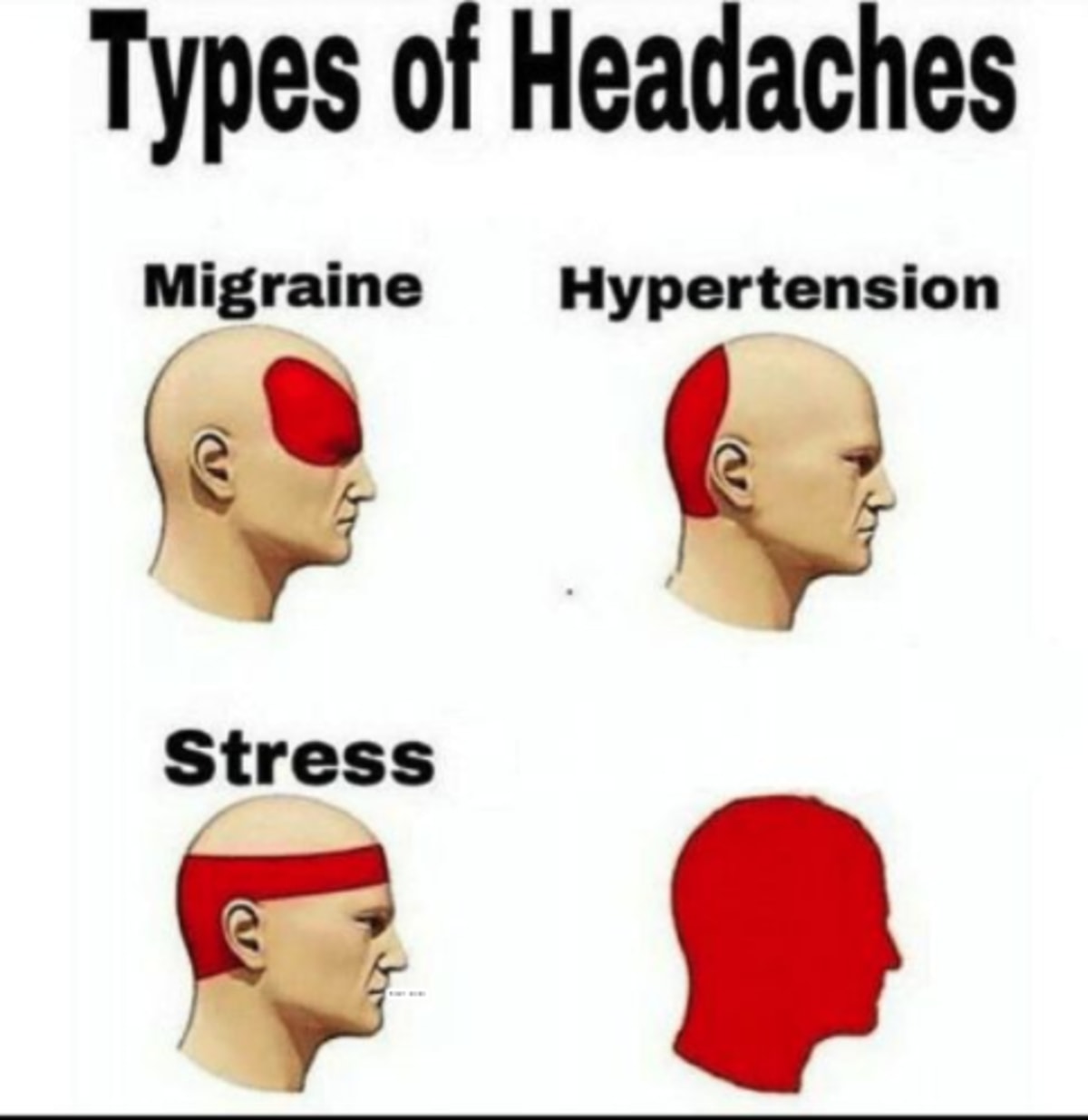 Types Of Headaches meme template: Four panels showing a human head with progressively larger areas of red to indicate pain severity, labeled Migraine, Hypertension, Stress, and a final, completely red head.