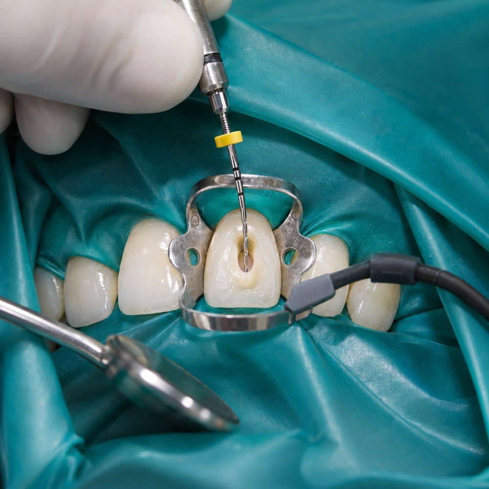 Endodoncia unirradicular