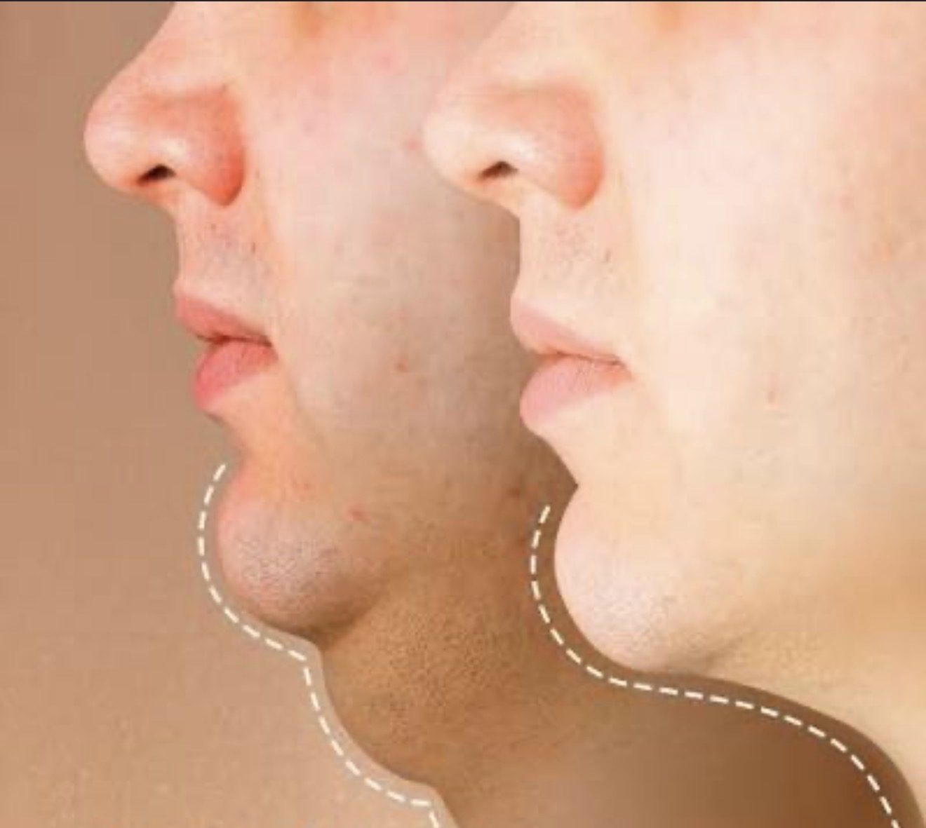 Cervicoplastía