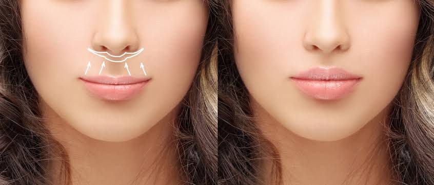 Lip lift 