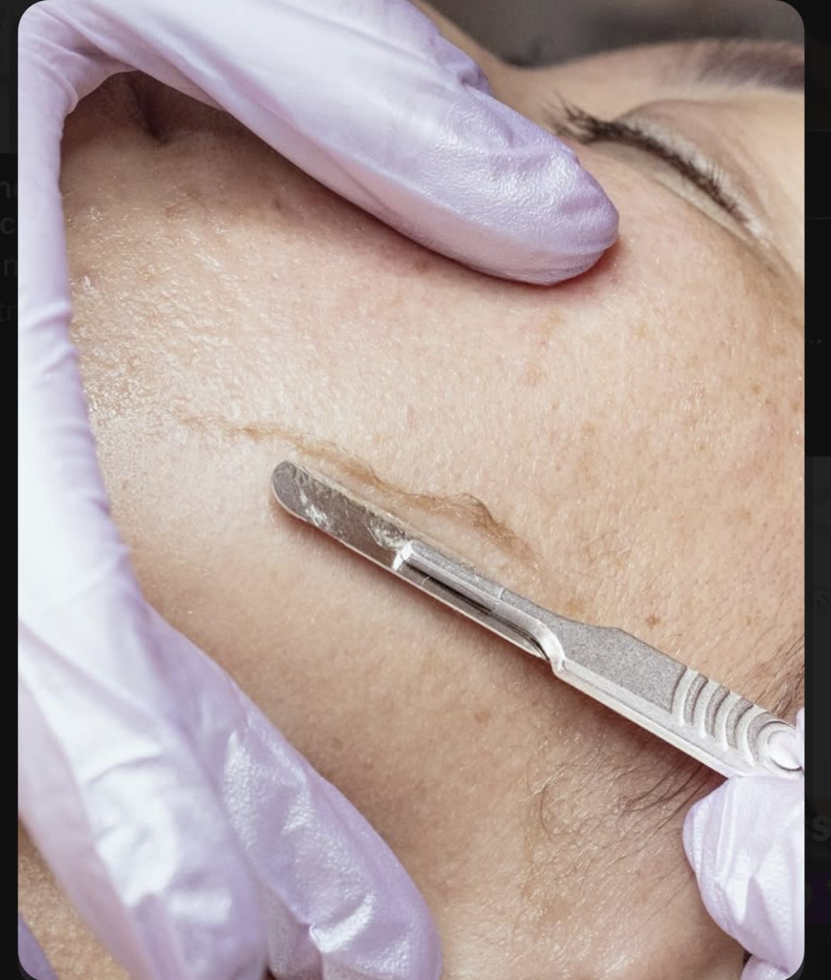 Dermaplaning 