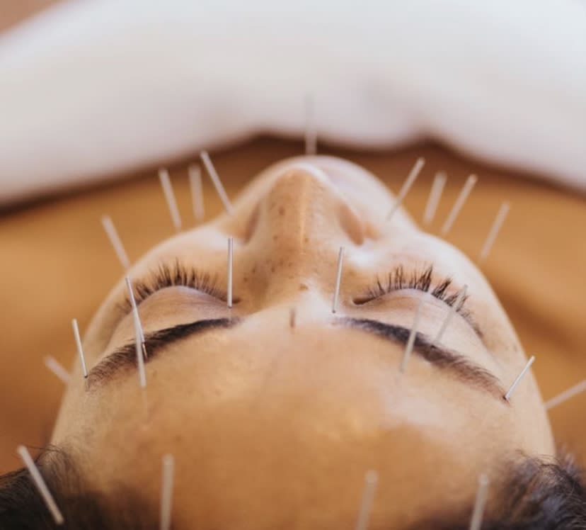 Tratamiento de Acupuntura