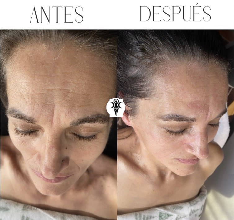 Facial Lifting Acupuntura - Indicaciones