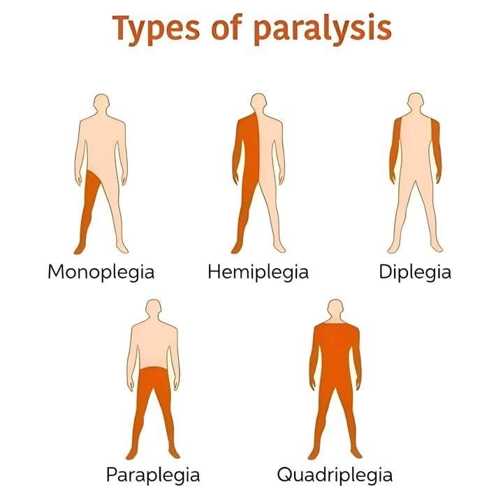Hemipleji (İnme) Nedir? Vücudun Verdiği Sinyaller ve Erken Rehabilitasyonun Önemi