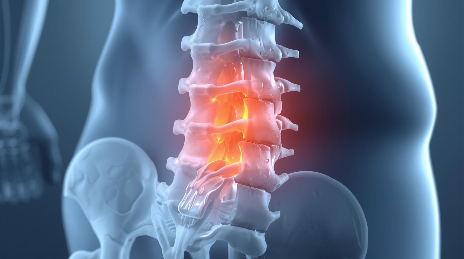 Bel Fıtığında Ameliyattan Kaçınmak Mümkün Mü? Süreci Kötüleştiren 4 Kritik Hata