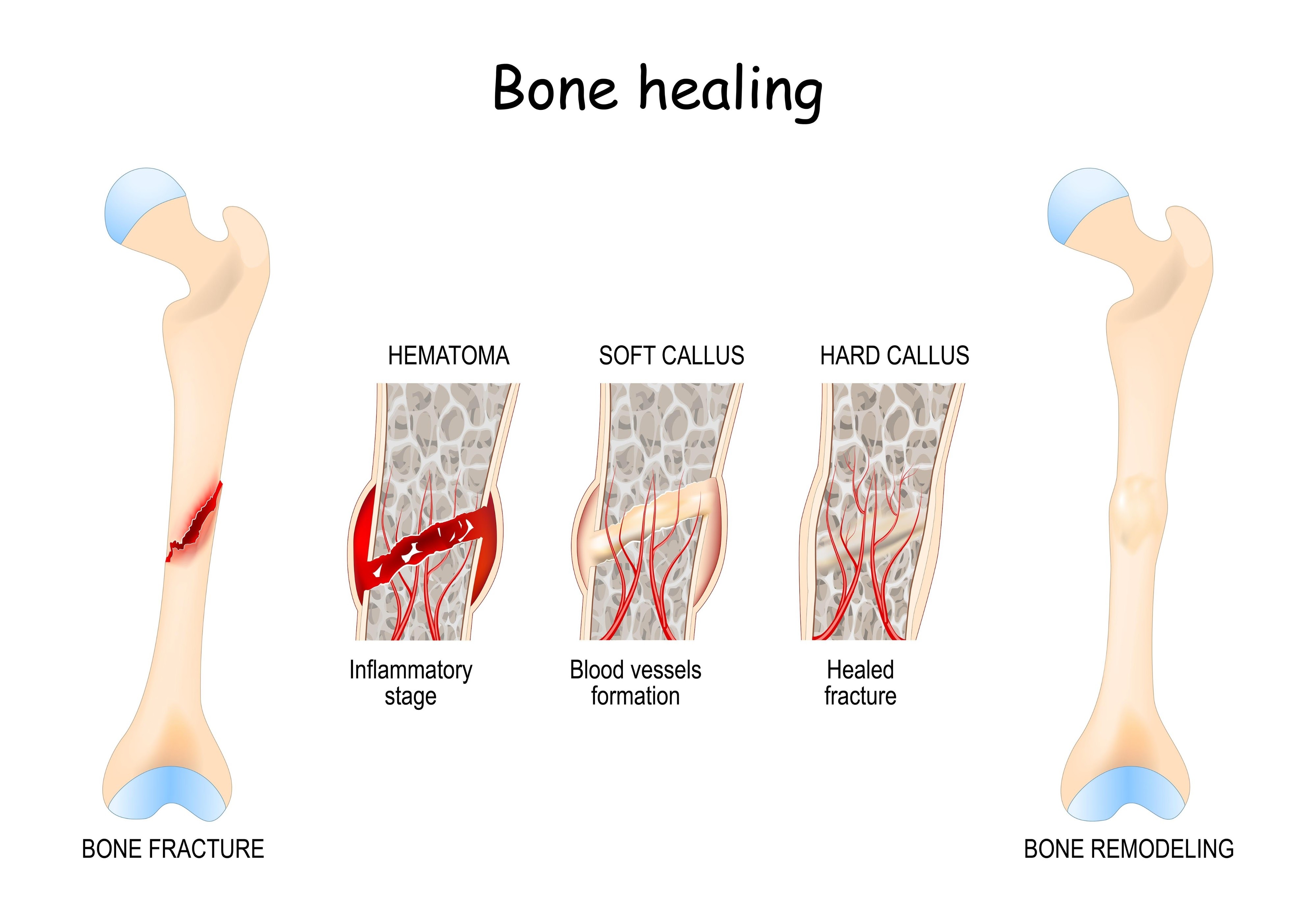 Kırık İyileşmesi
