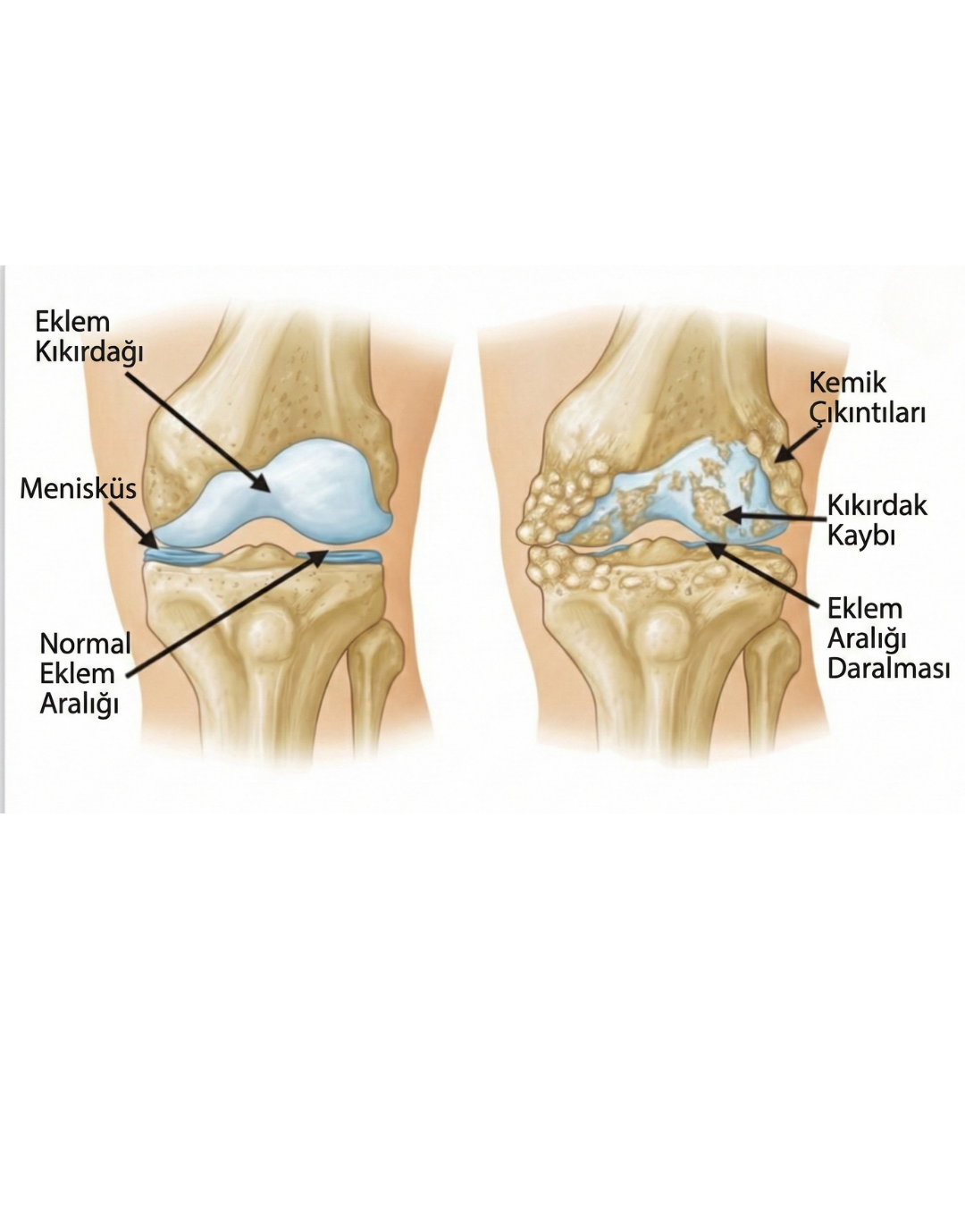 Diz Kireçlenmesi Nedir? Diz Kireçlenmesine Ne İyi Gelir?