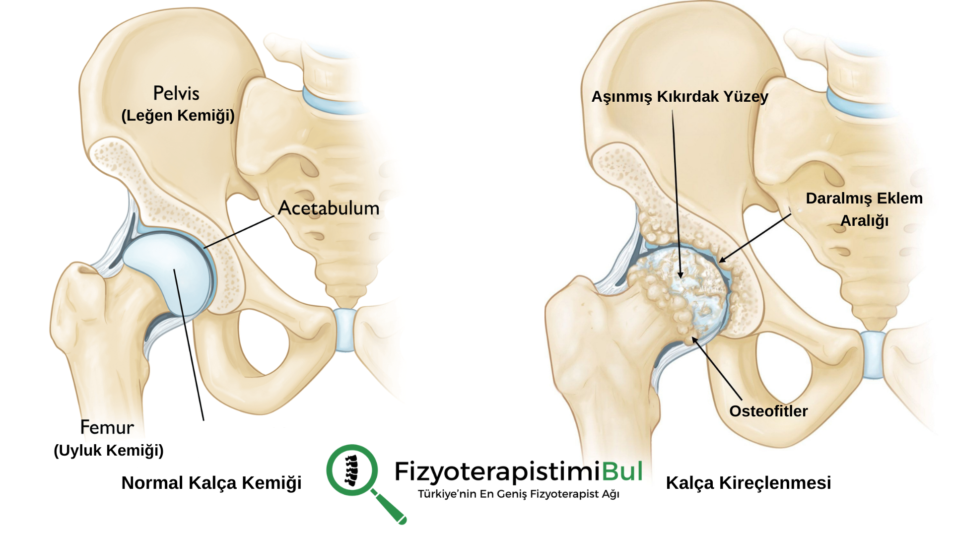 Kalça Kireçlenmesi (Koksartroz): Belirtileri, Nedenleri ve Kanıta Dayalı Egzersiz Rehberi