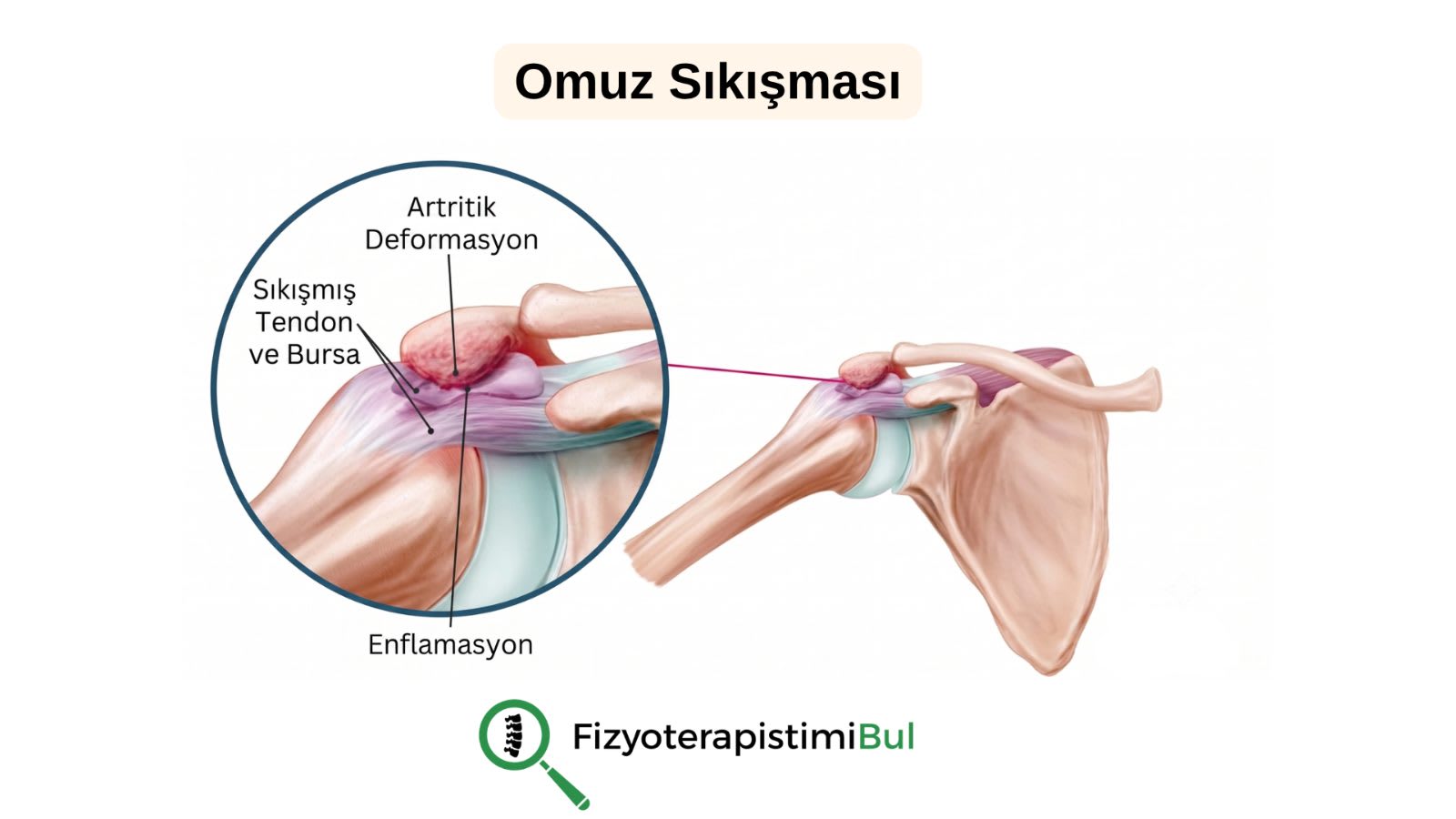 Omuz Sıkışma (İmpingement) Sendromu Nedir? Belirtileri ve Tedavisi