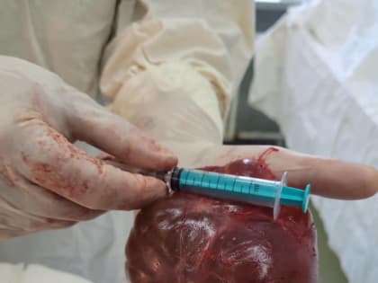 Хабаровские врачи удалили огромную опухоль