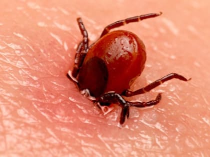 В Вологодской области с начала года клещи покусали уже больше 7 тысяч человек