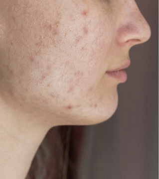 Demystifying the Drip: The Truth About Glutathione IV for Skin Whitening