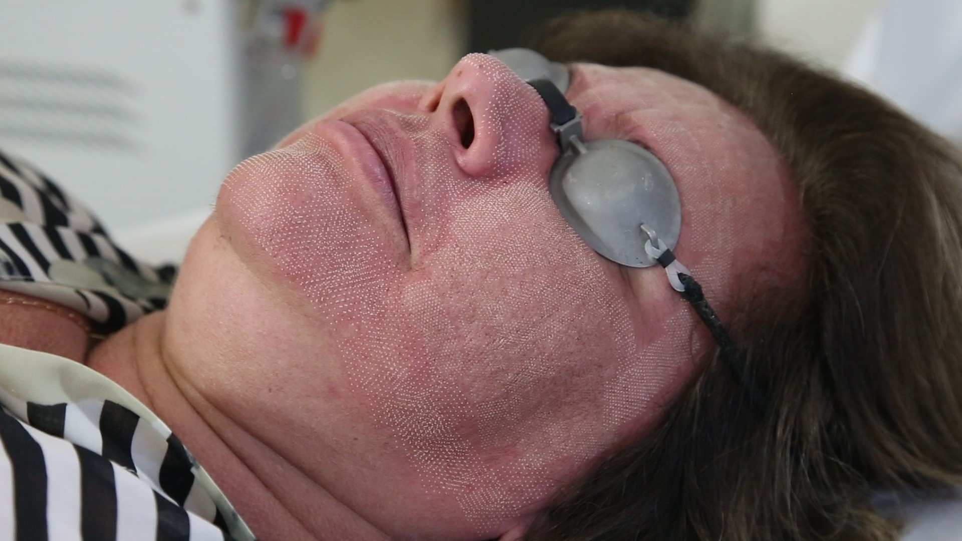 pós laser de co2