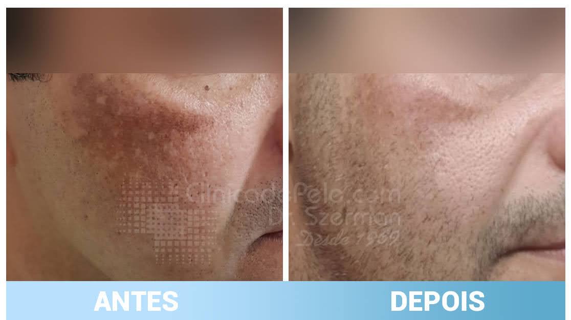 antes e depois melasma