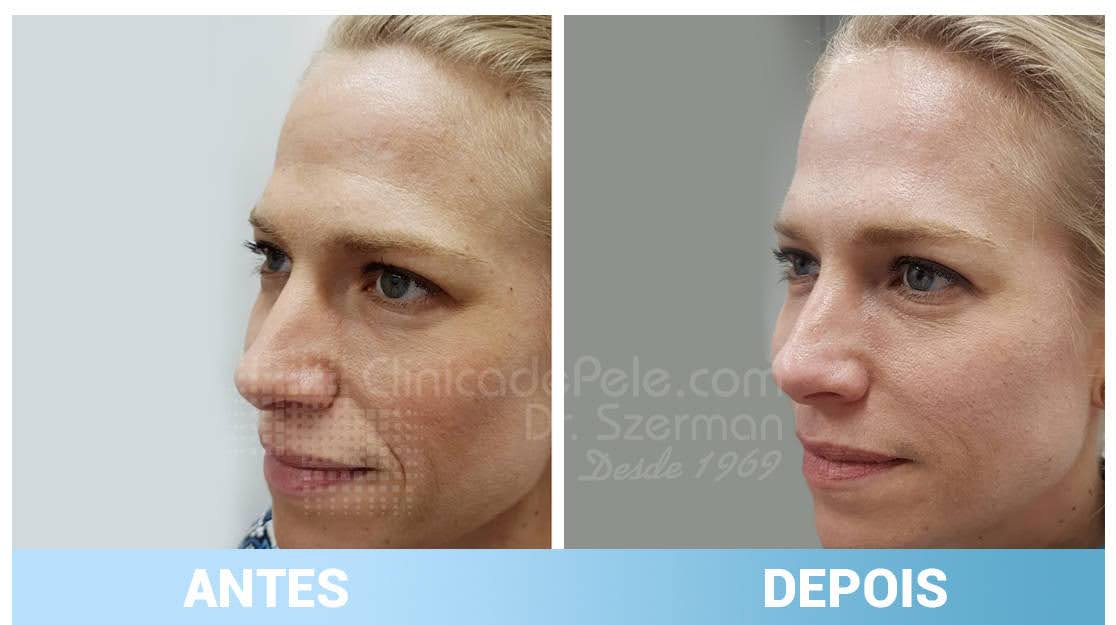 antes e depois rugas