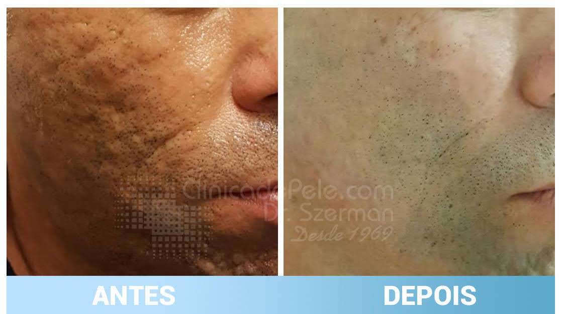antes e depois cicatrizes de acne