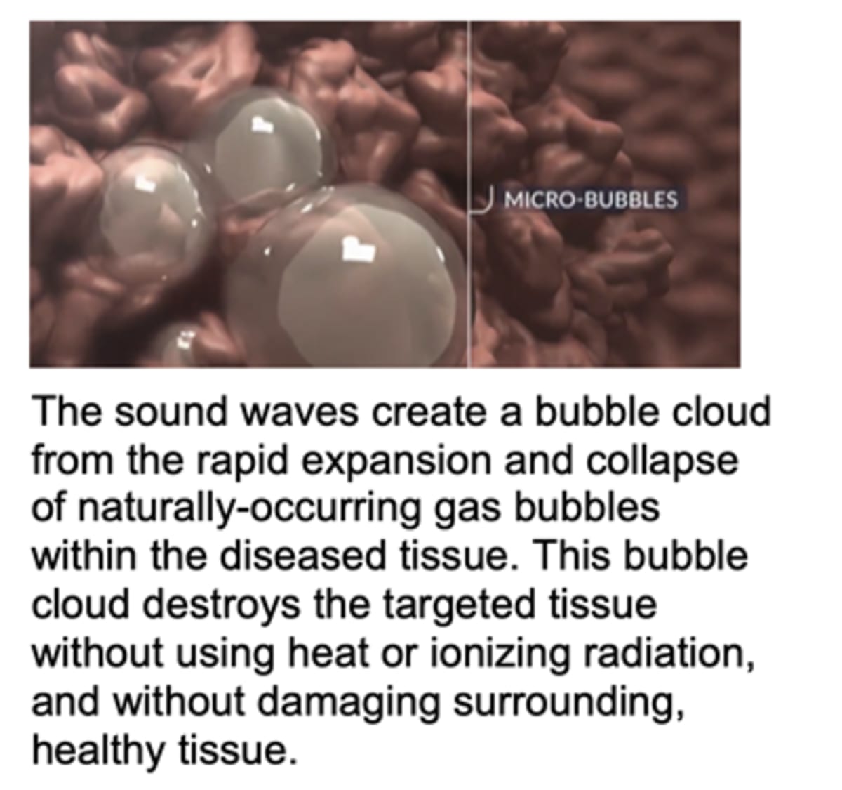 Florida Hospital Destroys Liver Tumors With Sound Waves - Image 2