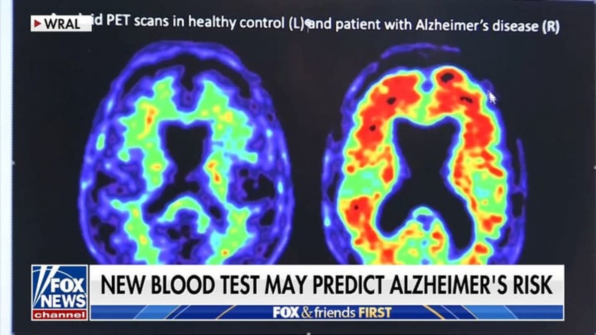 New Alzheimer's Treatments Give Families Hope After Decades - Image 4