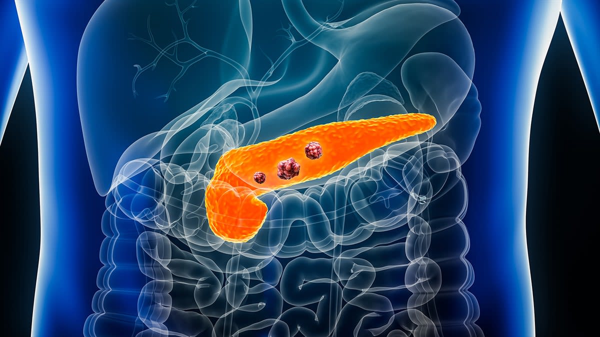 New Pancreatic Cancer Pill Shows 90% Control Rate in Trial - Image 5