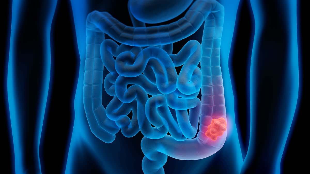 New Blood Tests Make Colon Cancer Screening Easier at 45 - Image 4