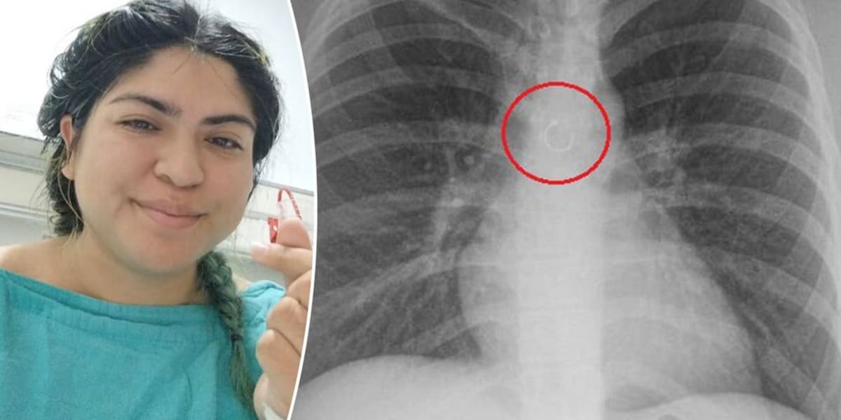 Woman's Missing Nose Ring Ends Up in Her Lung, Survives - Image 2