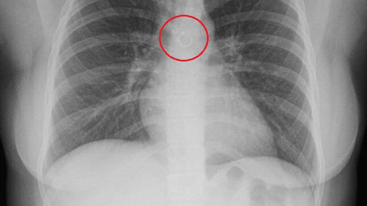 Woman's Missing Nose Ring Ends Up in Her Lung, Survives - Image 4