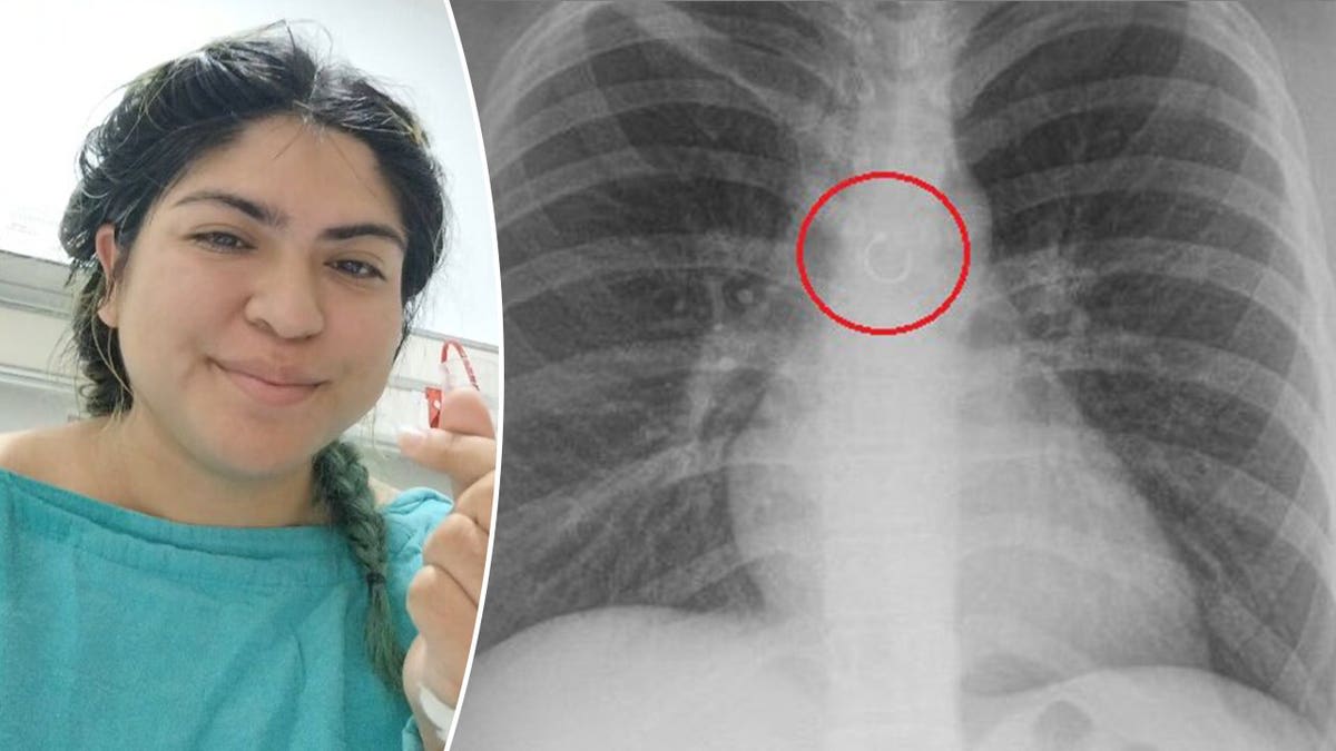 Woman's Missing Nose Ring Ends Up in Her Lung, Survives - Image 5