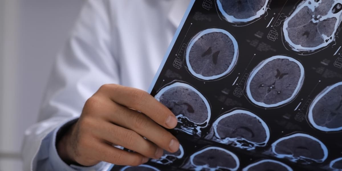 Tapeworms in Brain Mistaken for Cancer, Man Fully Recovers - Image 2