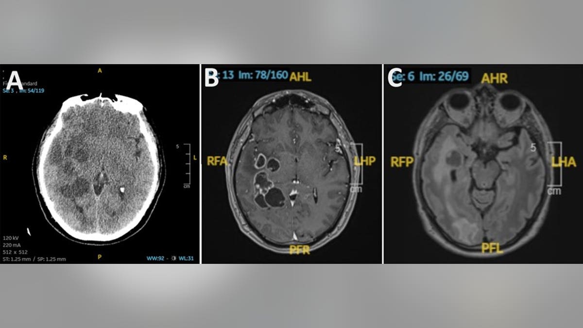 Tapeworms in Brain Mistaken for Cancer, Man Fully Recovers - Image 4