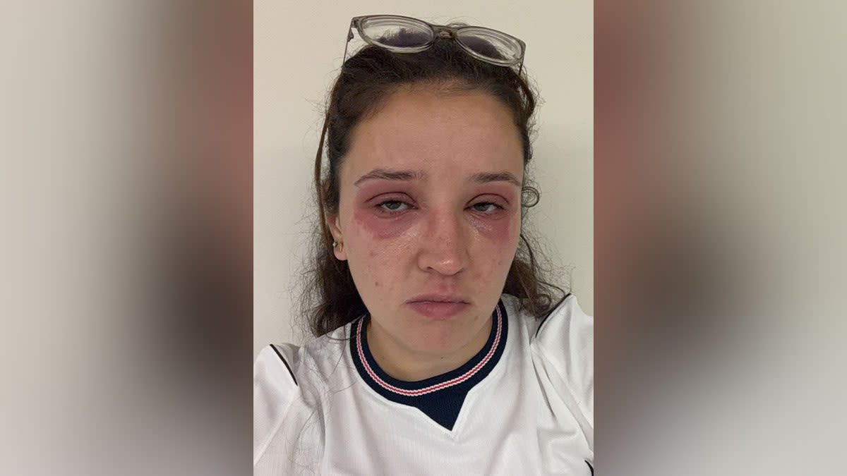 Bride's Eyelash Disaster Saves Others From Same Fate - Image 4