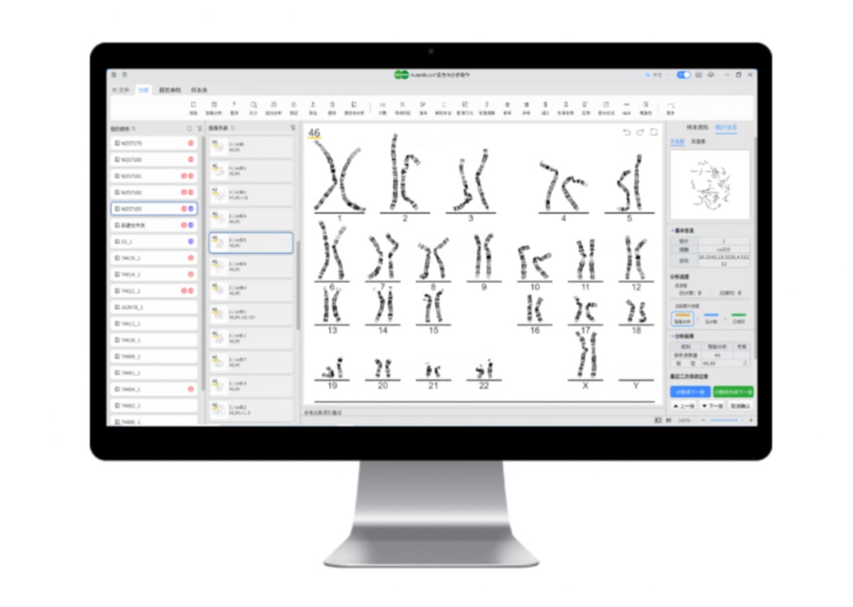 Medical professional reviewing chromosome analysis results displayed on computer screen with AI assistance