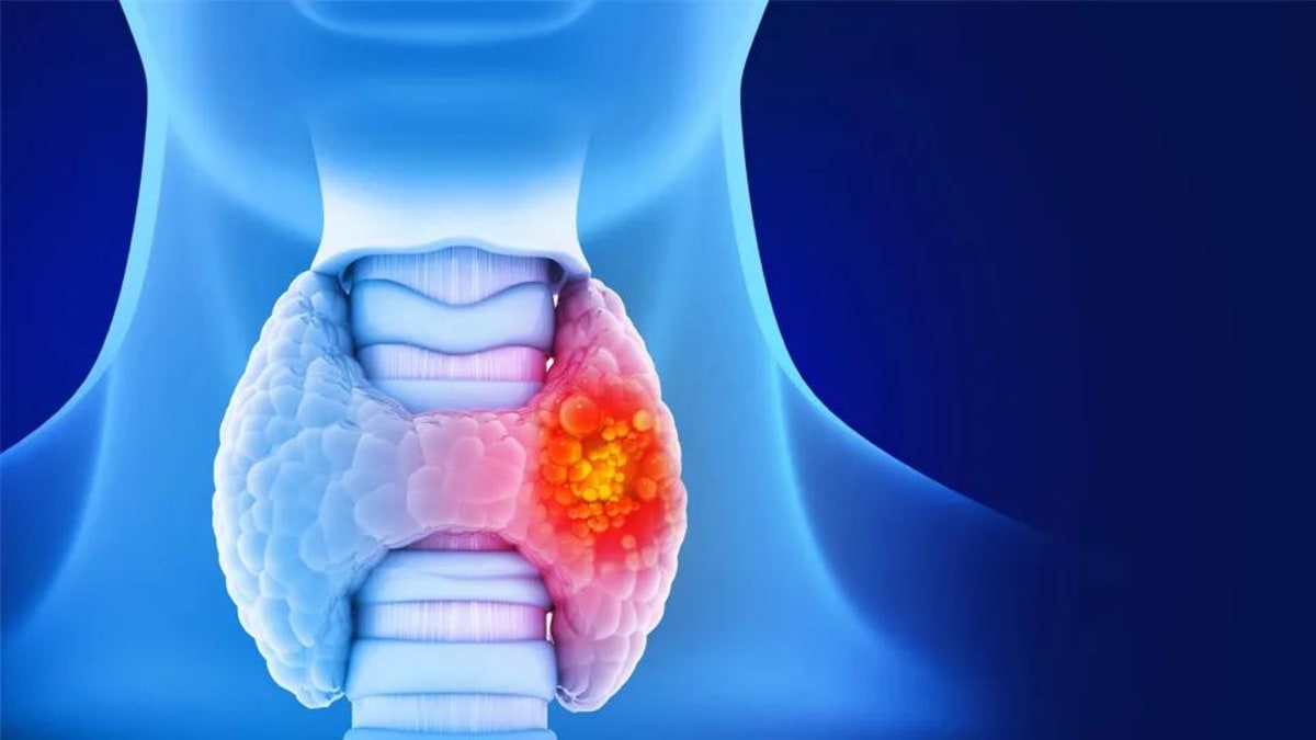 New Thyroid Cancer Treatments Transform Survival Odds