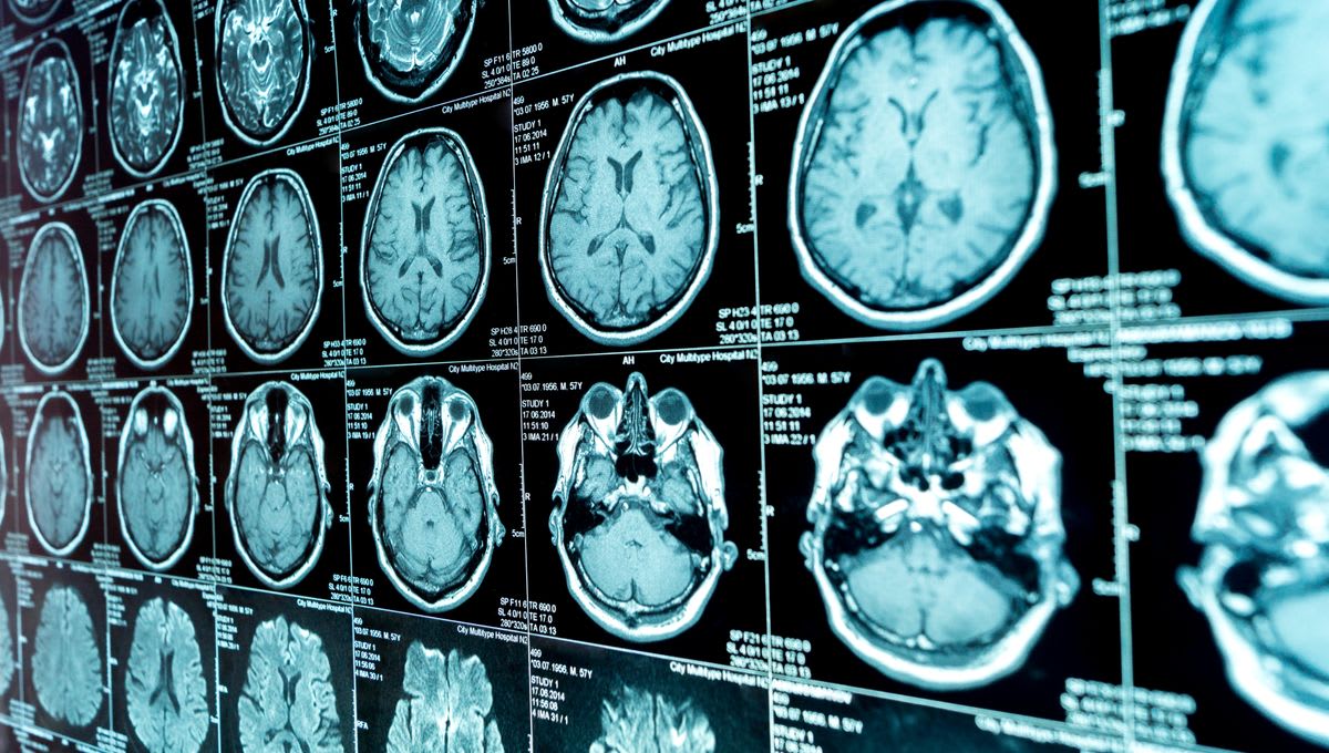 Scientists Find 3 Types of ADHD Using Brain Scans