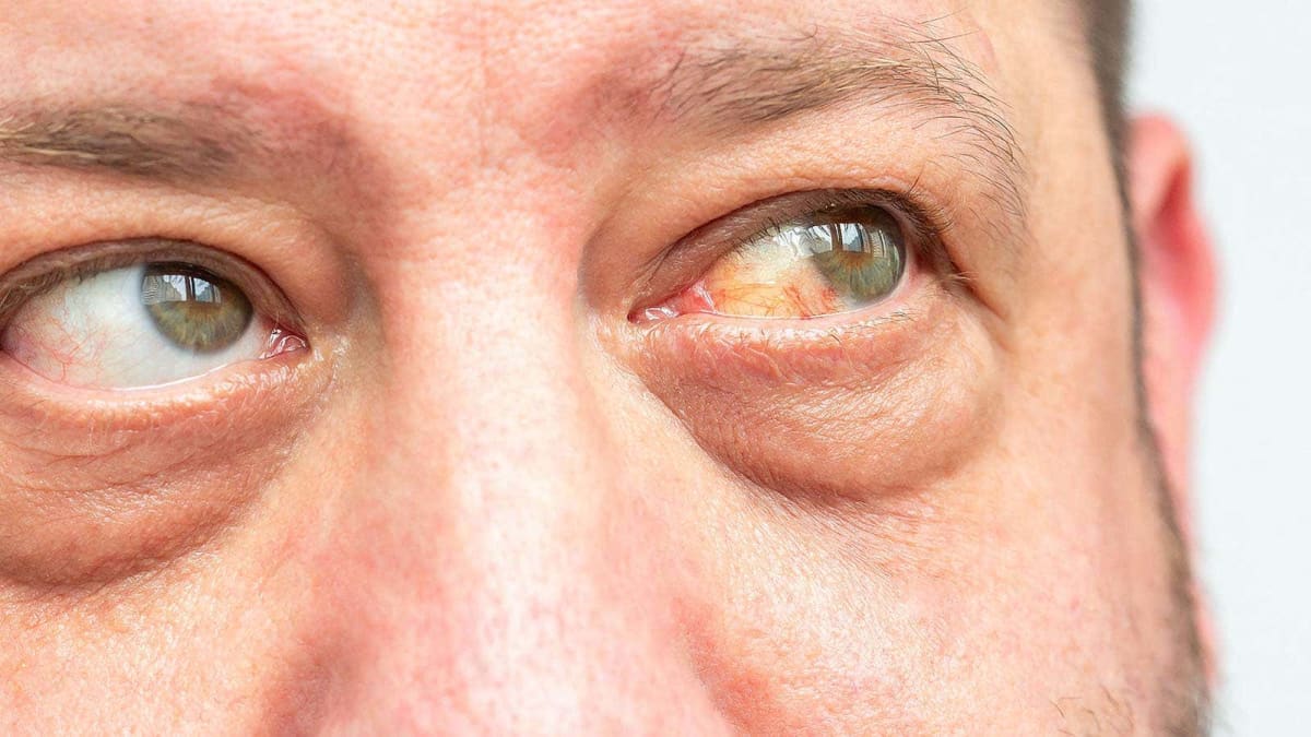 FDA Approves New Drug for Thyroid Eye Disease Patients