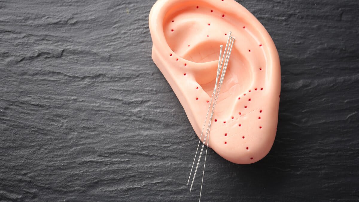 Ear Acupuncture Shows Promise for Chronic Migraine Relief - Image 2