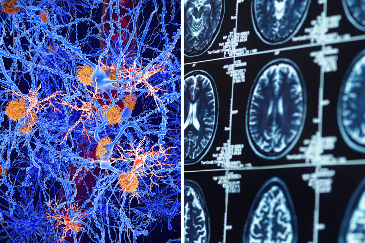 Colorful illustration of neurons with protein vesicles traveling between brain cells representing Alzheimer's research breakthrough