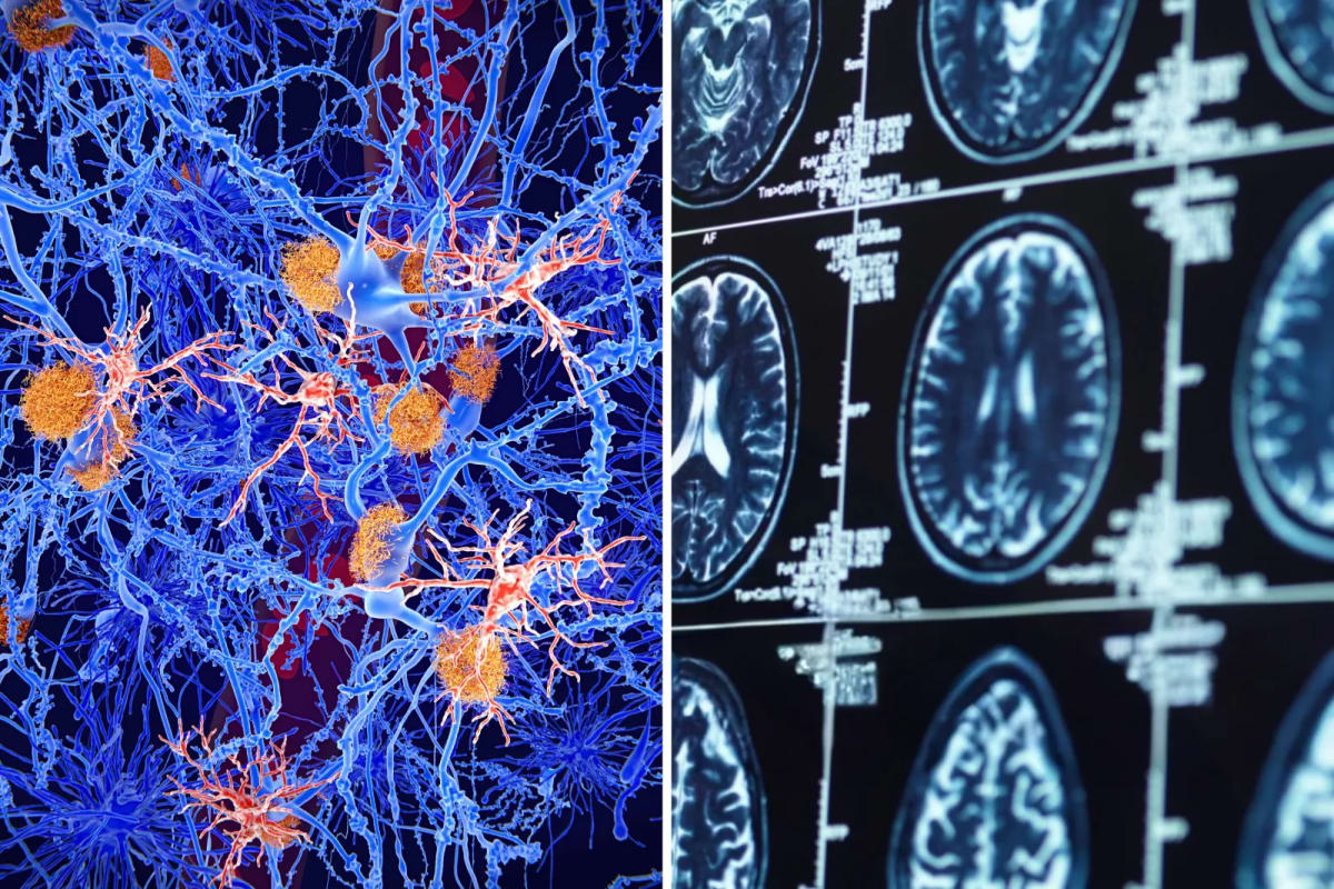 Scientists Find How Alzheimer's Spreads and Way to Stop It - Image 3