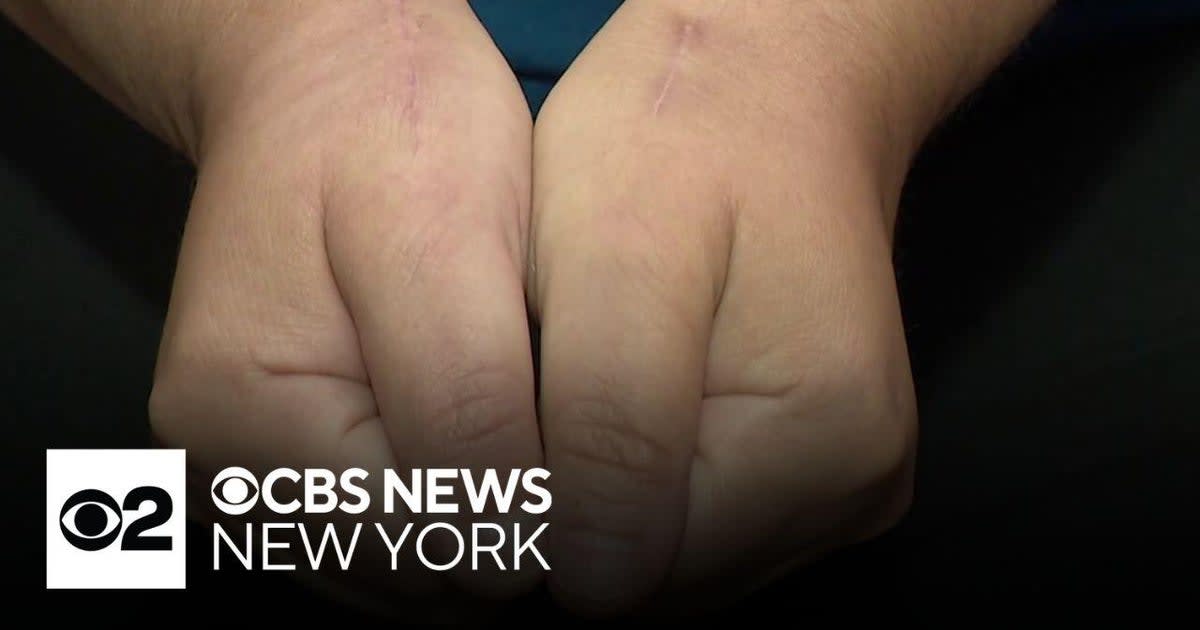 New Thumb Surgery Relieves Arthritis Pain for Patients
