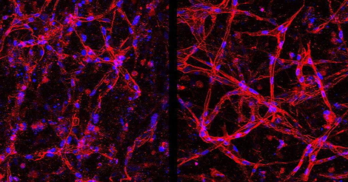 Side-by-side comparison showing healthy and deteriorated human retinal cells under microscope view