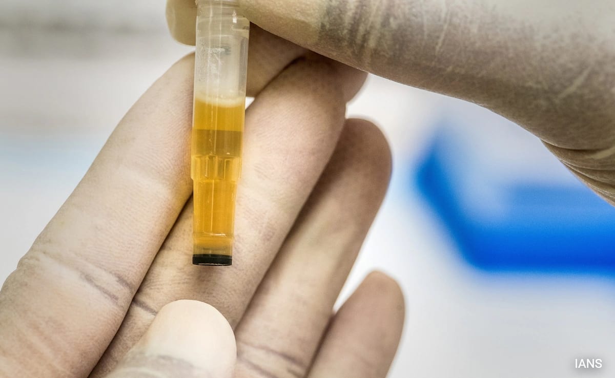 New Home Urine Test Detects 92% of Bladder Cancers - Image 2