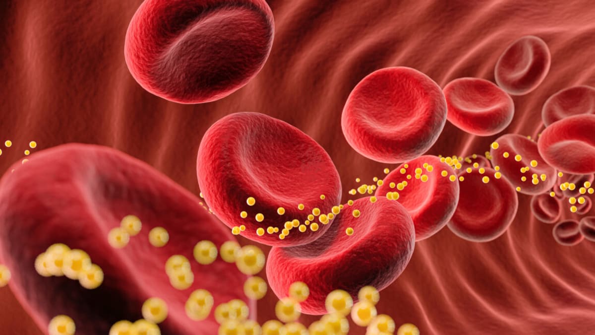Gene Therapy Cuts Bad Cholesterol 62% With Single Dose