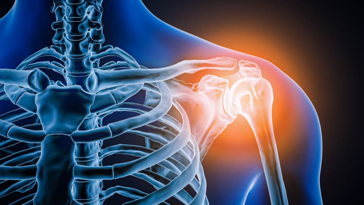 X-ray showing construction worker's destroyed shoulder joint with floating arm bone beside swollen shoulder photo
