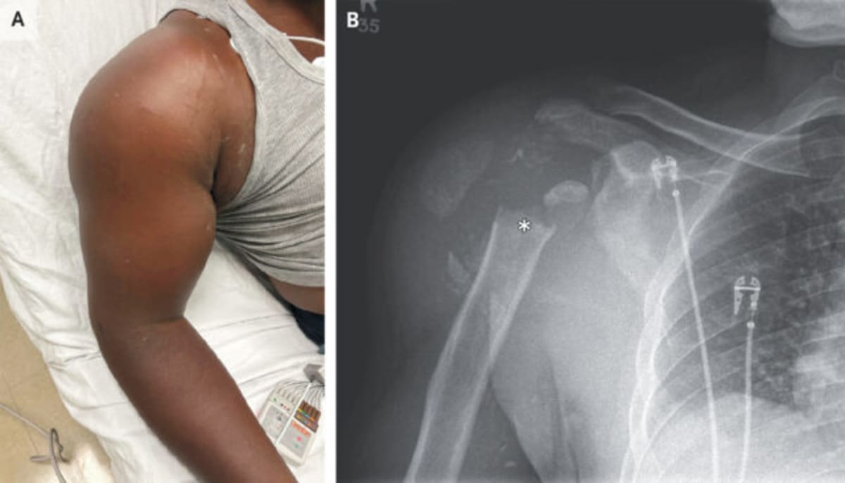 Doctors Save Construction Worker After Shoulder Vanishes - Image 2