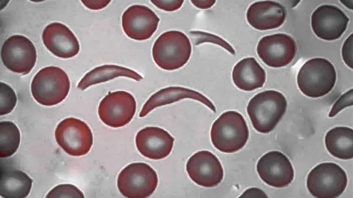 FDA Approves Gene Therapy for Kids 2+ With Sickle Cell