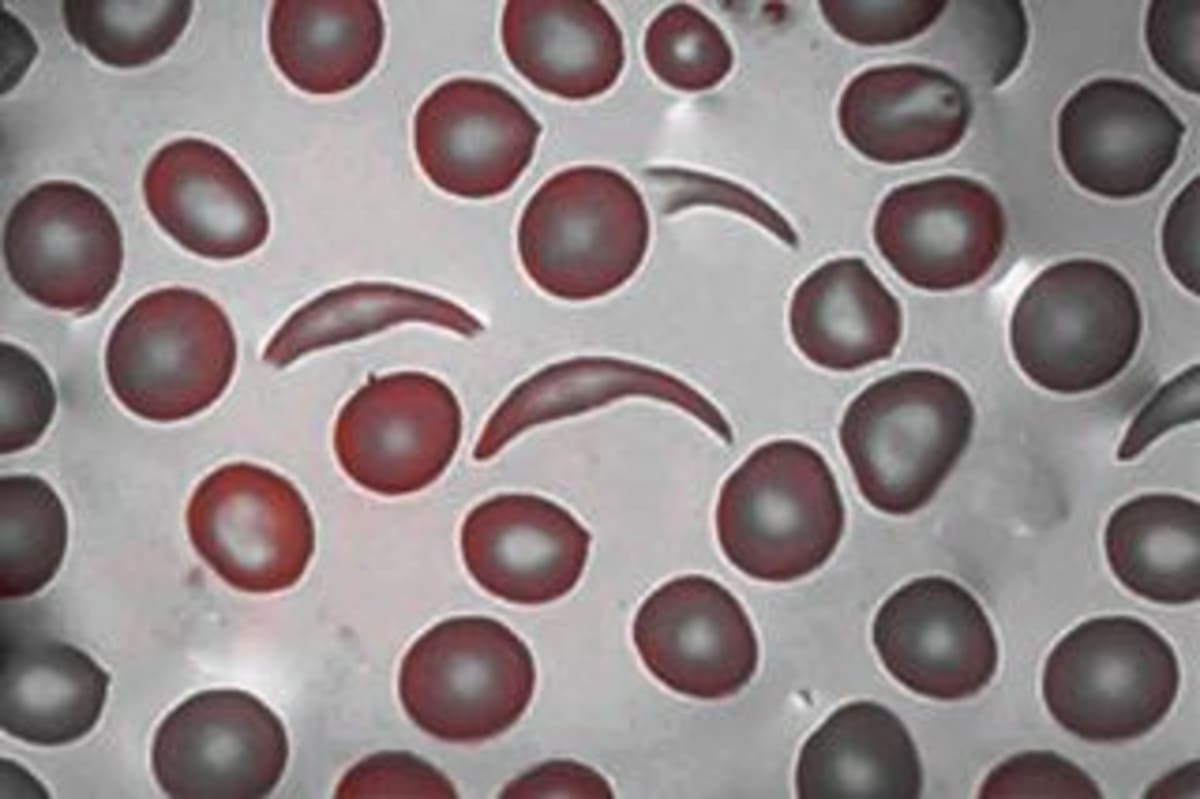 FDA Approves Gene Therapy for Kids 2+ With Sickle Cell - Image 3