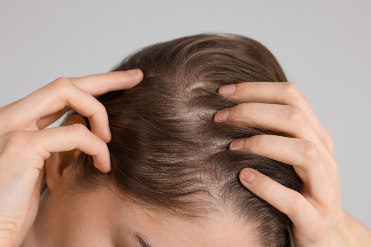 Arthritis Drug Restores Full Hair in 20% of Alopecia Patients - Image 2