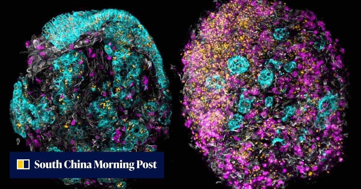 Blood Test Solves Cancer's Hardest Mystery in Days