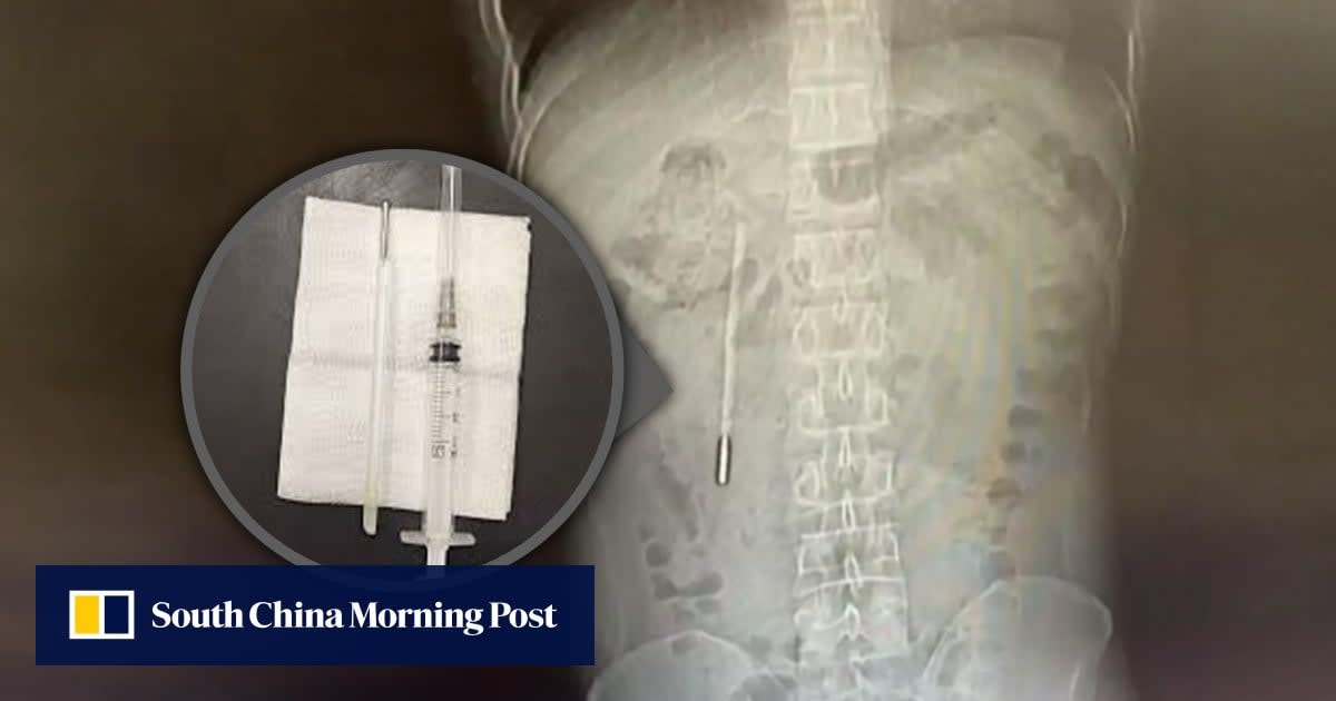 X-ray image showing mercury thermometer lodged inside patient's digestive system after two decades